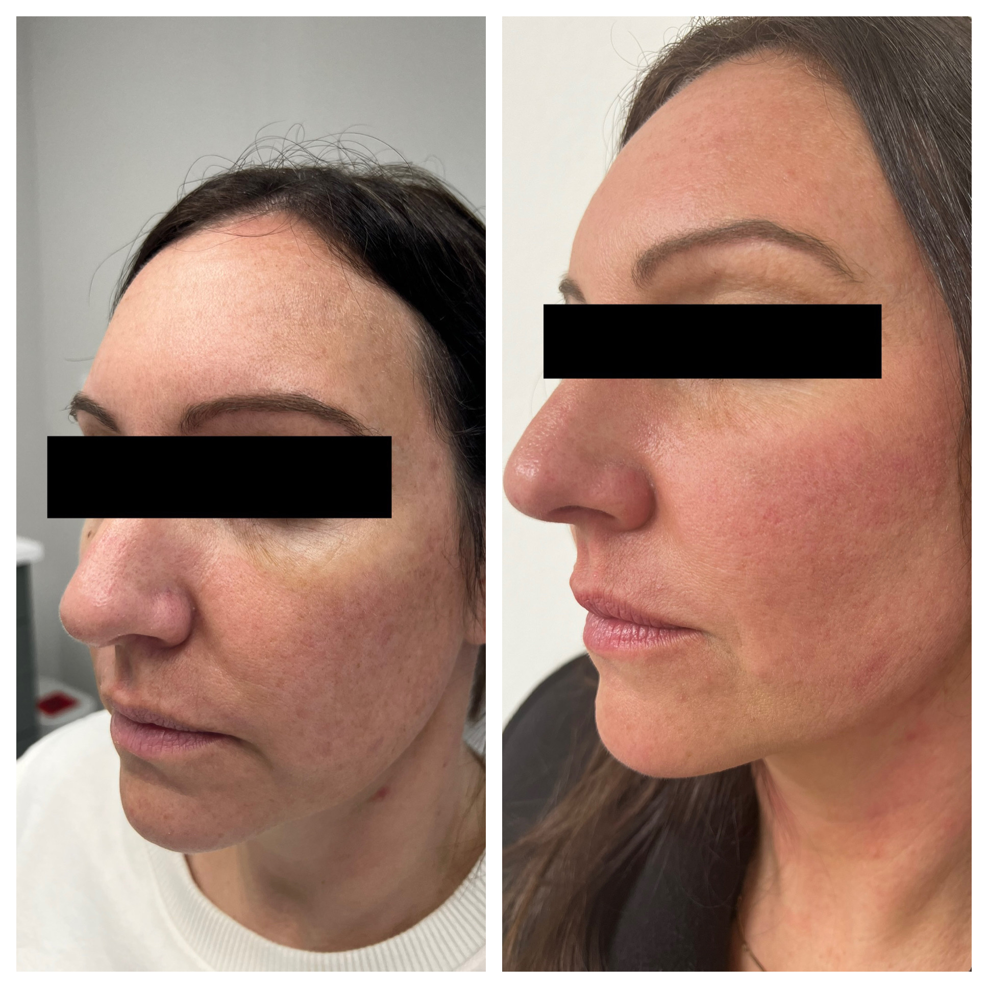 Filler - Before/After - SculptME Med Spa