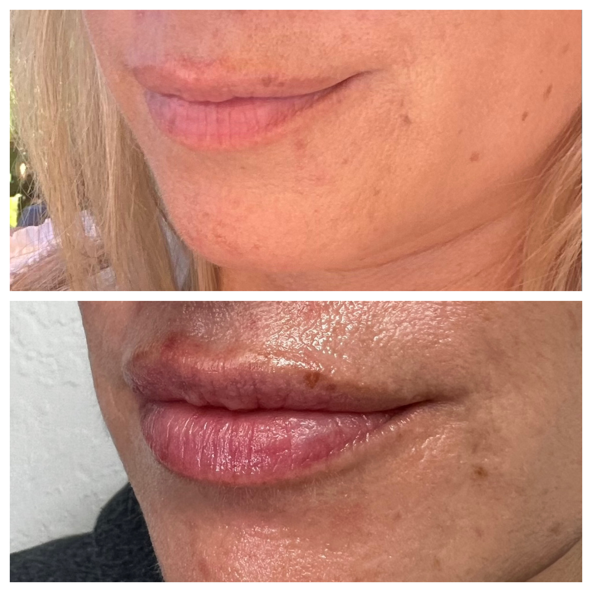 Filler - Before/After - SculptME Med Spa