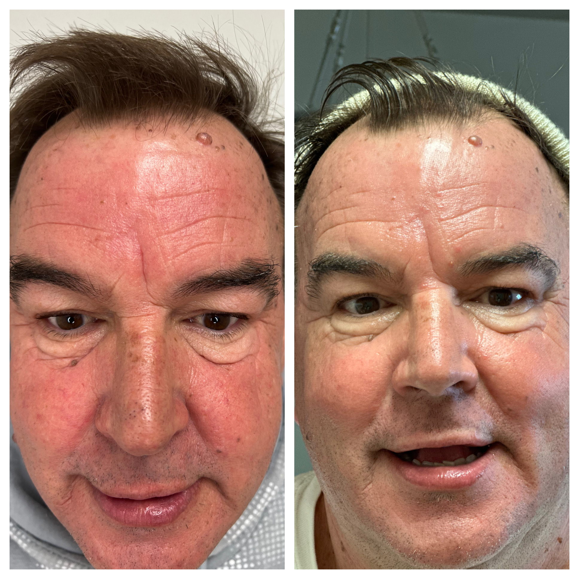 CO2 Laser - Before/After - SculptME Med Spa