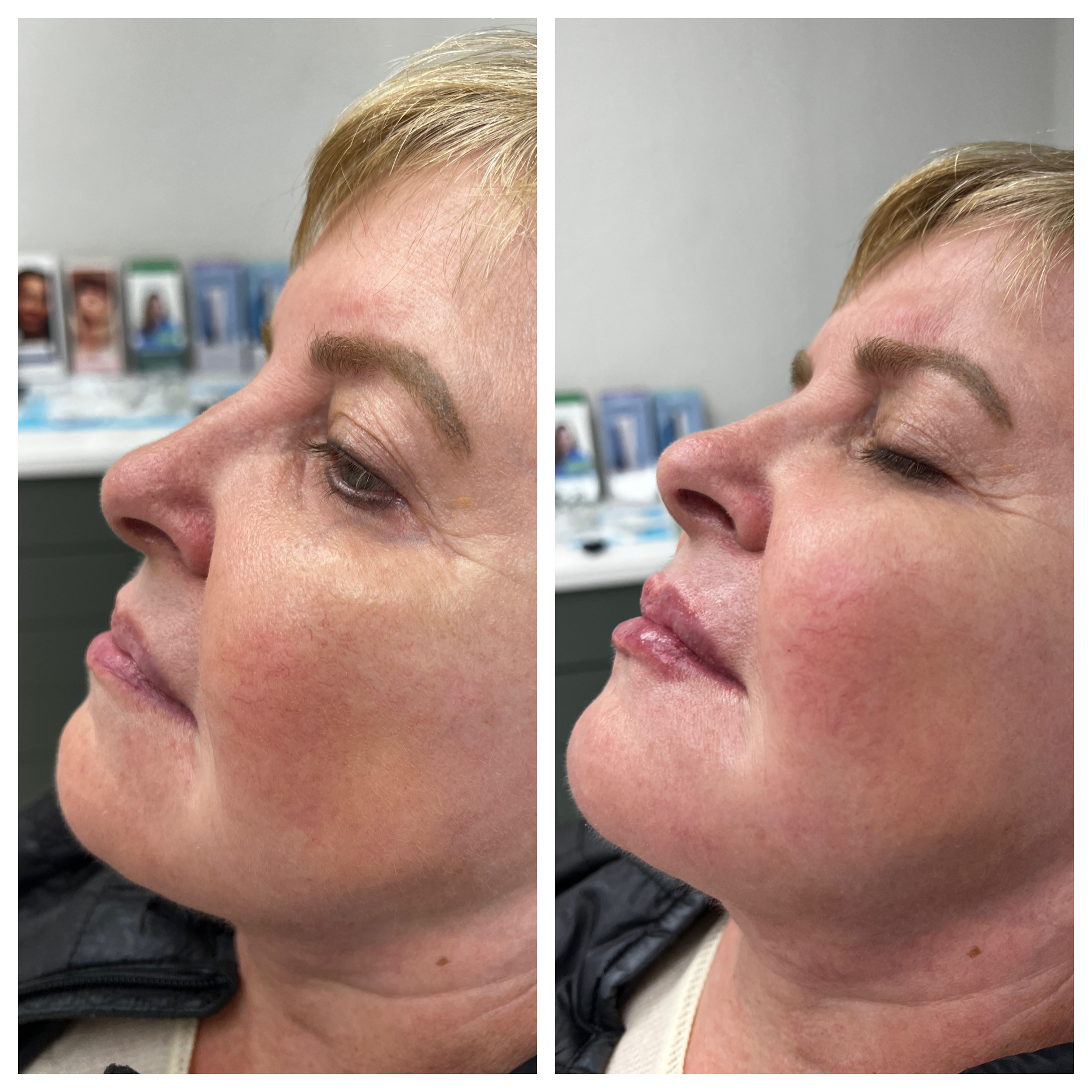 Filler - Before/After - SculptME Med Spa