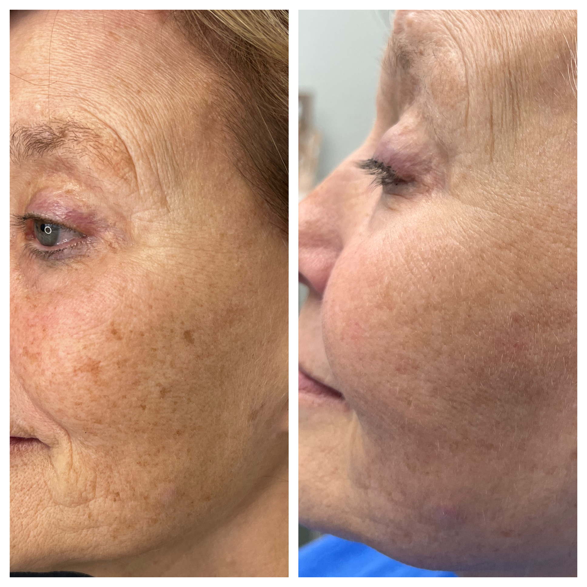 IPL - Before/After - SculptME Med Spa