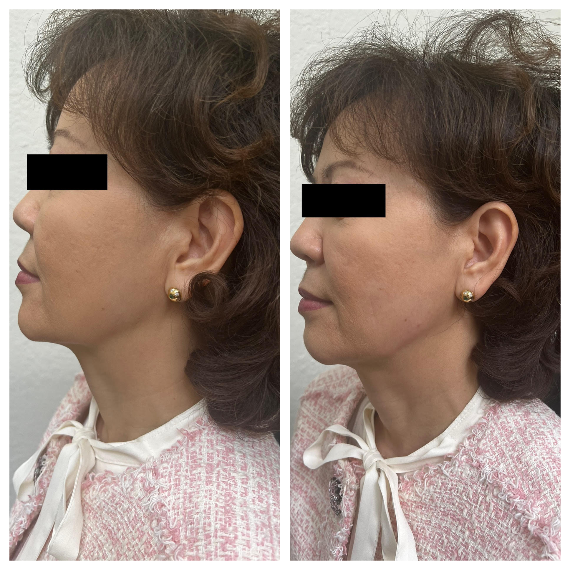 Filler - Before/After - SculptME Med Spa