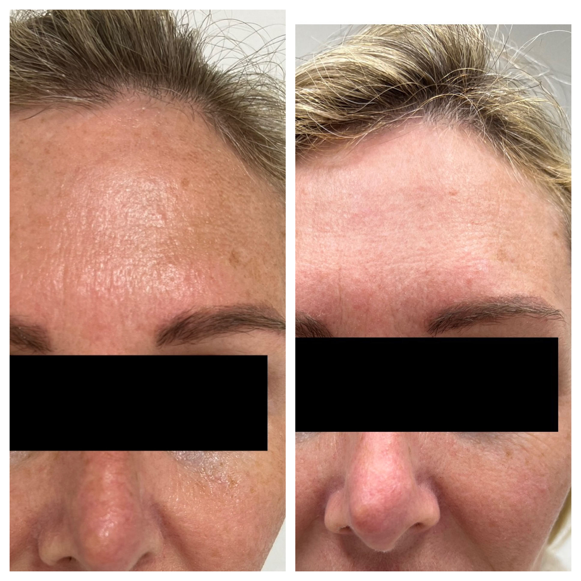 RF Microneedling - Before/After - SculptME Med Spa