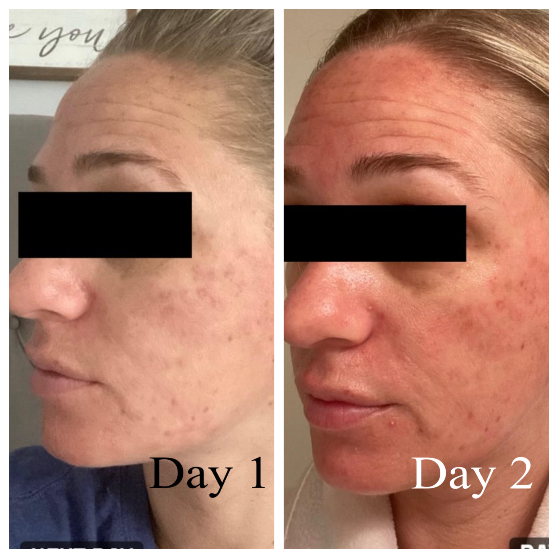 Skin Resurfacing - Before/After - SculptME Med Spa