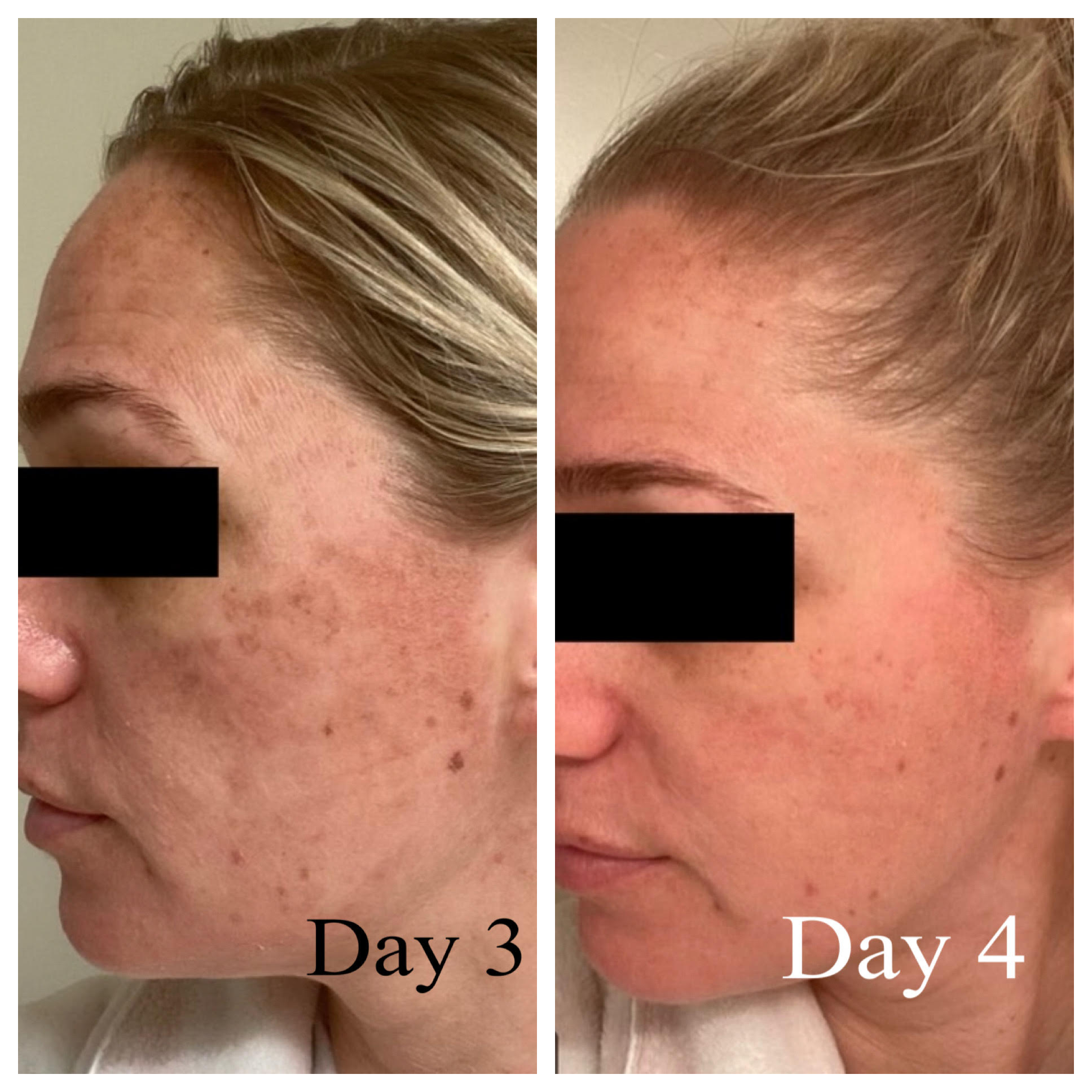 Skin Resurfacing - Before/After - SculptME Med Spa