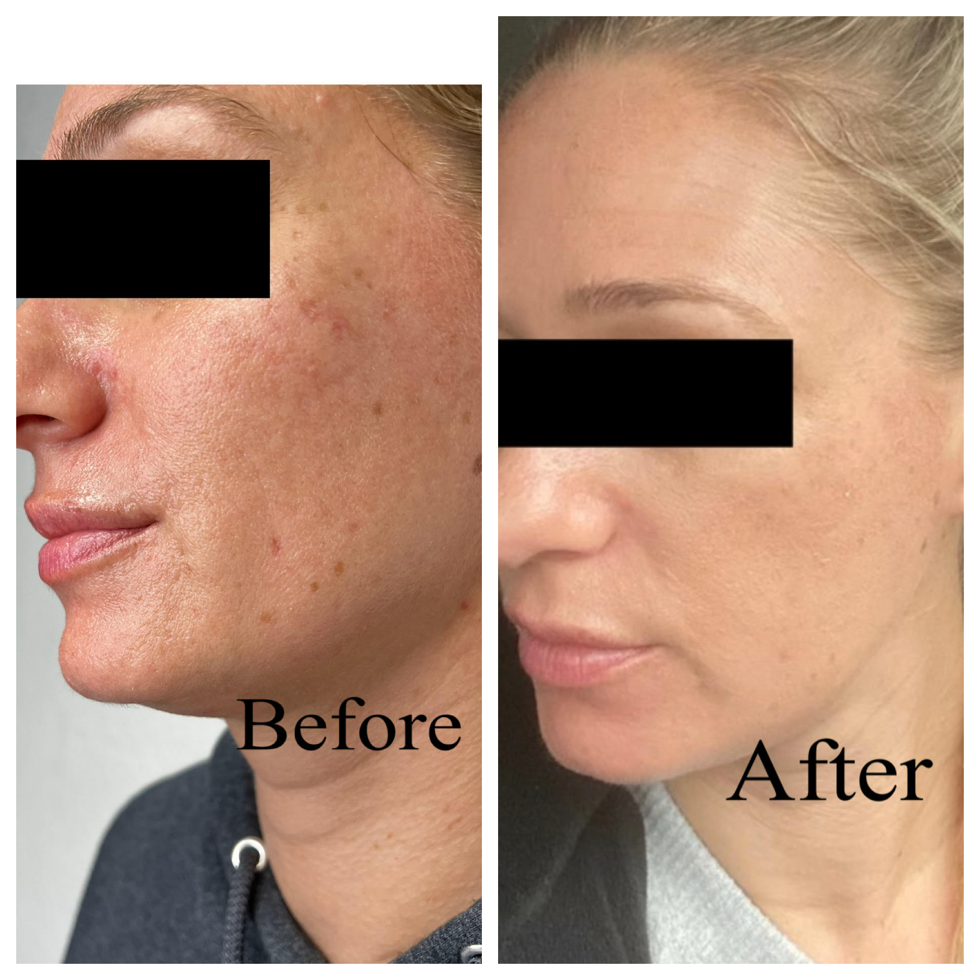 Skin Resurfacing - Before/After - SculptME Med Spa