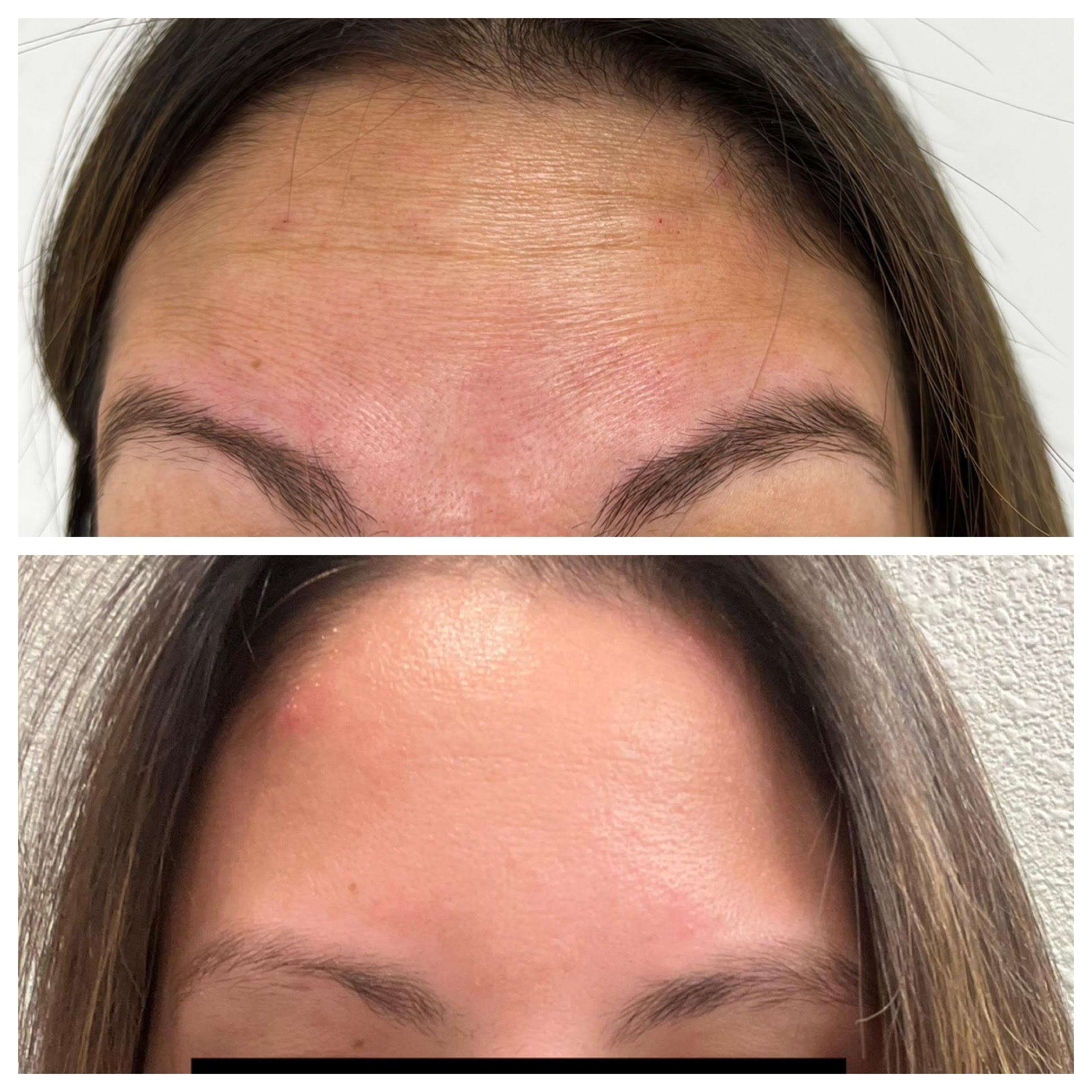 Filler - Before/After - SculptME Med Spa