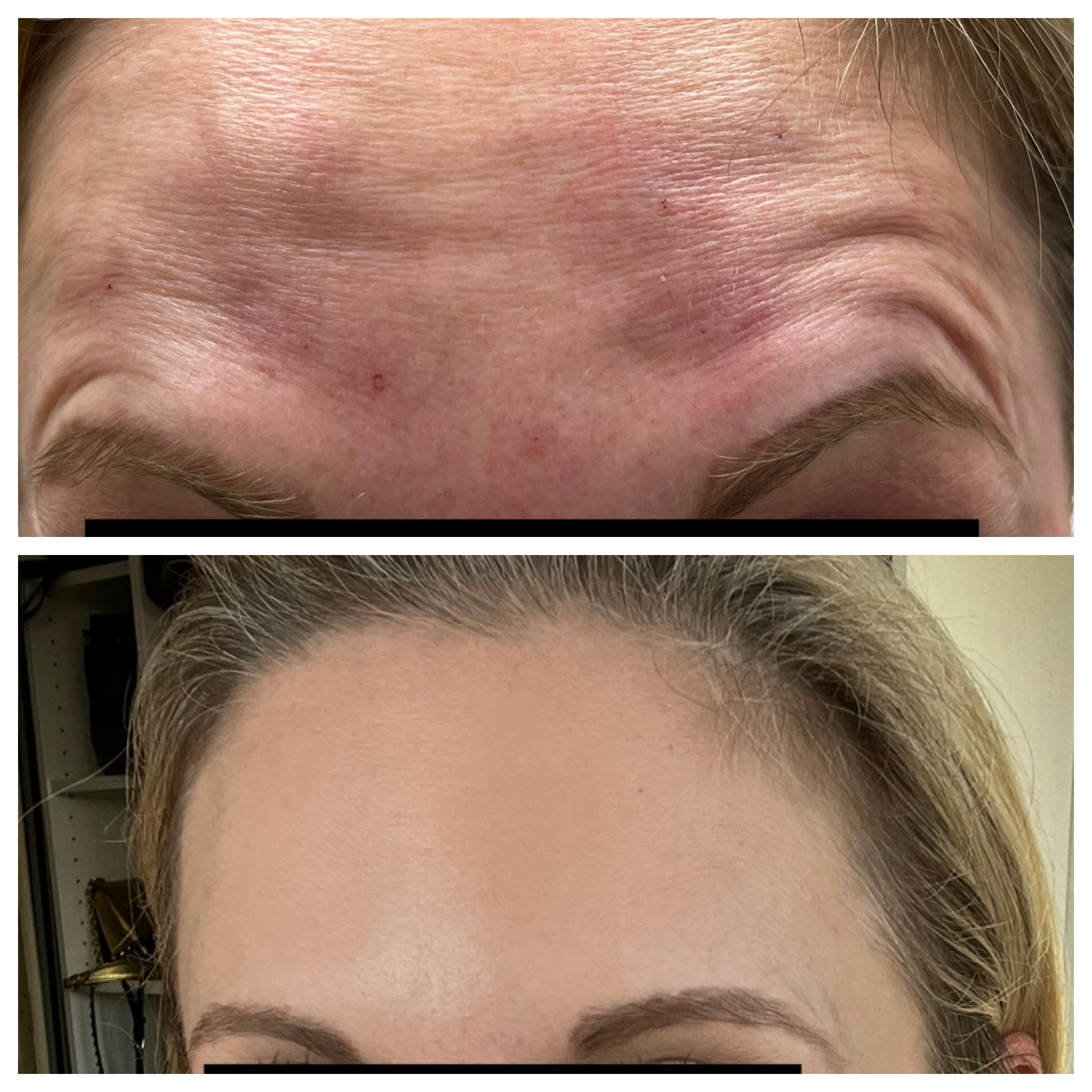 Filler - Before/After - SculptME Med Spa